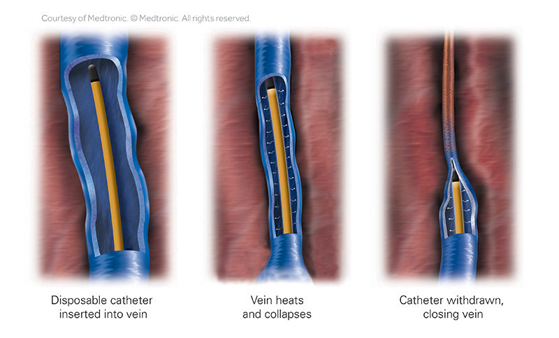 Image of ClosureSeal thermal catheter