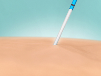 Image of VenaSeal